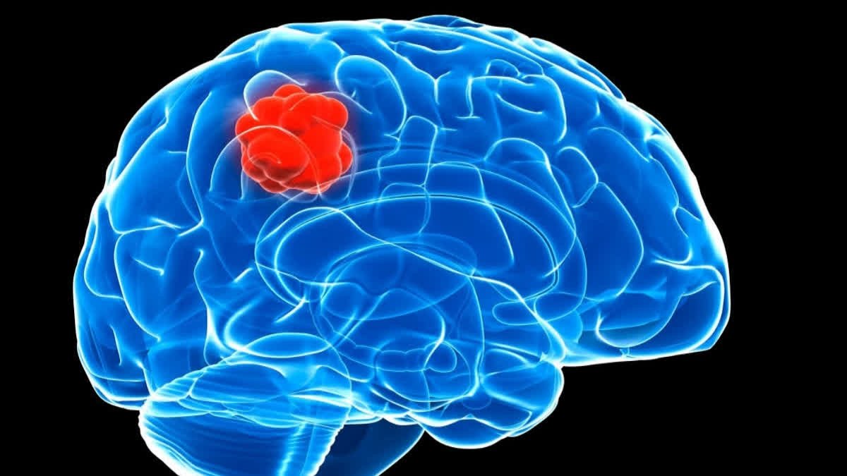 How Modern Neurosurgery Is Making Brain Tumour Treatment Safer Than Ever